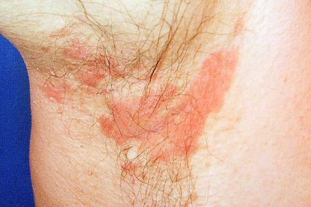 Seborrheic dermatitis rash in an armpit