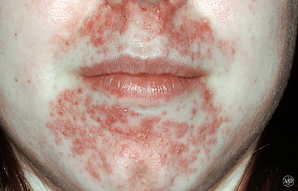 Acne-like rash caused by medication