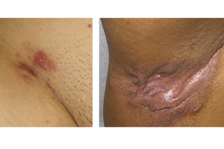 Hidradenitis suppurativa manifesting as hyperpigmented scars and
