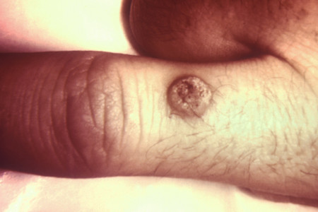 Human papillomavirus (HPV)