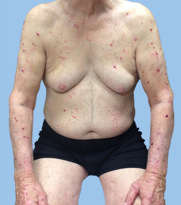 Image for DWII on pruritus, from JAAD 2016; 75: 774-781