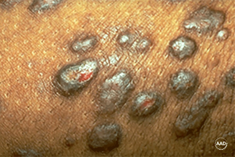 Close-up of brownish black bumps on patient’s skin, with some bumps open and bleeding.