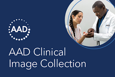 Card illustration for AAD Clinical Image Collection