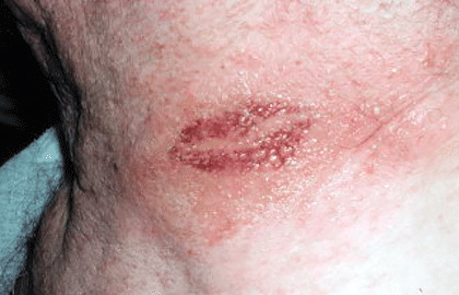 Tattoo Rash Symptoms Causes  Treatment  AuthorityTattoo