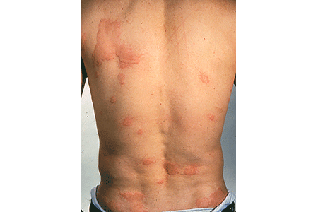 Hives on back.