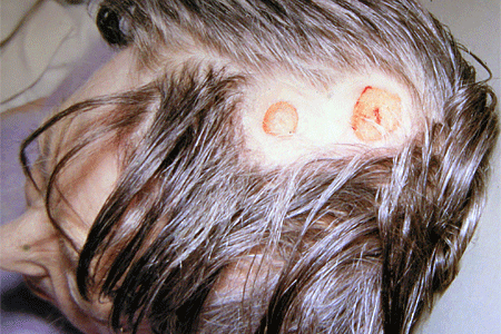 Syphilis gummas on patients scalp