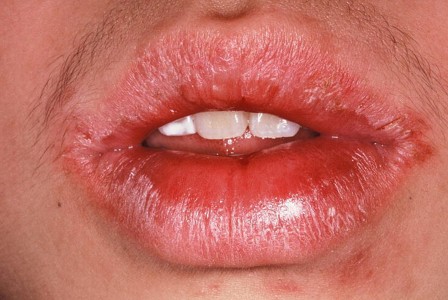 Image for DWII on fecal calprotectin