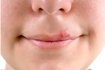 cold sore on upper lip