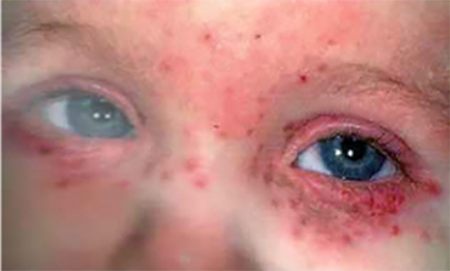 herpes simplex virus on child's eye