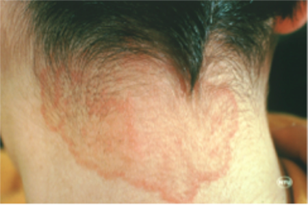 Ringworm rash on back of the neck