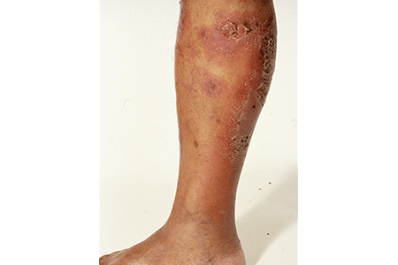 Generalized pustular psoriasis on patient's leg