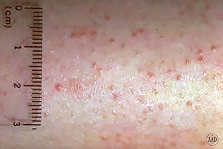 Keratosis Pilaris: Overview