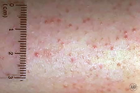 Keratosis pilaris causes tiny bumps on the skin