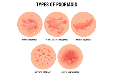 Psoriasis skin disease, types