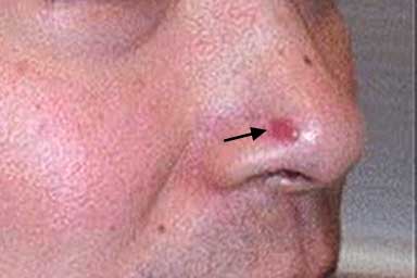 What looks like a pinkish, red sore on this patient’s nose is basal cell carcinoma | American Academy of Dermatology
