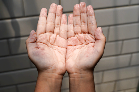 Man with hyperhidrosis holding out his hands, sees that his palms are wrinkly and swollen.