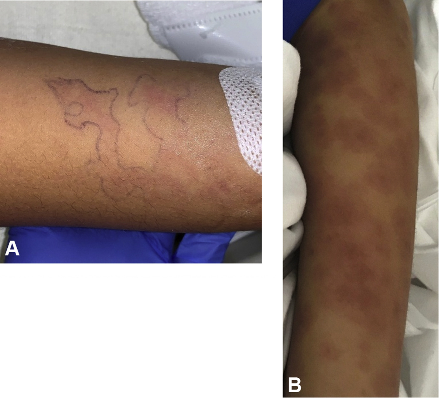 Figure 2. A and B, Mucocutaneous disease in children and adolescents with MISC-C. A, Retiform purpura, arm. B, Targetoid erythema, arm. Source: JAAD. (5)
