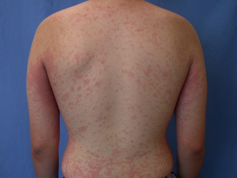 A man's trunk showing pityriasis rosea | American Academy of Dermatology (AAD).