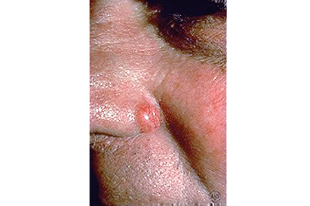 Reddish, round basal cell carcinoma on patient’s nose