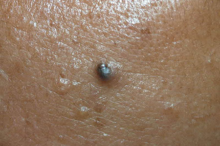 Skin cancer can look like a shiny growth that’s black, brown, or blue