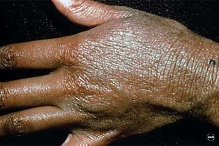 Atopic dermatitis caused thickened, discolored skin that itches most of the time