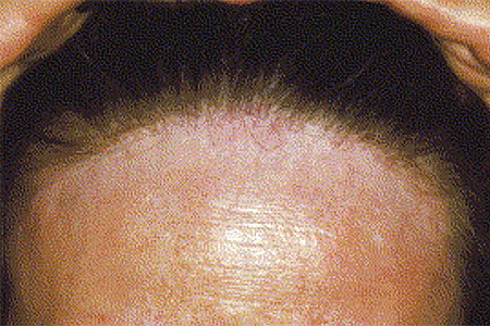 Band of lighter skin along woman’s front hairline reveals hair loss.