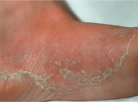Ringworm infection on sole of foot