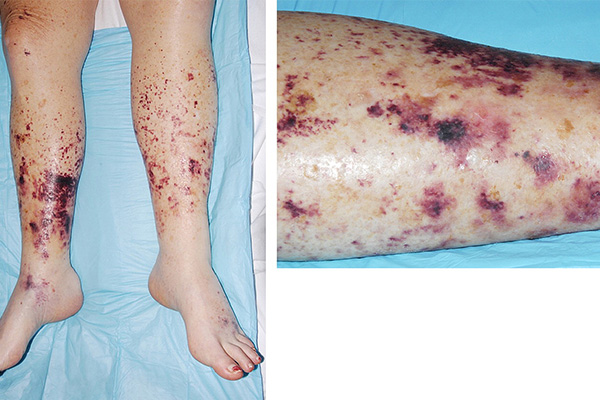 Figure 1. This patient had purpura fulminans in association with disseminated intravascular coagulation. Biopsy specimens showed no evidence of vasculitis. Source: JAAD. (4)