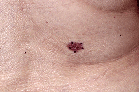 Brown basal cell carcinoma with area of normal-looking skin in the center