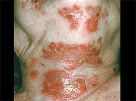 Pemphigus: Signs And Symptoms