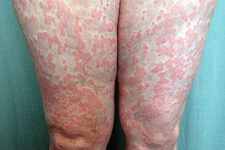 Widespread hives on legs