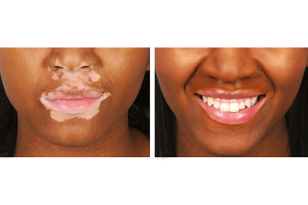 Patient with vitiligo before and after applying camouflage makeup