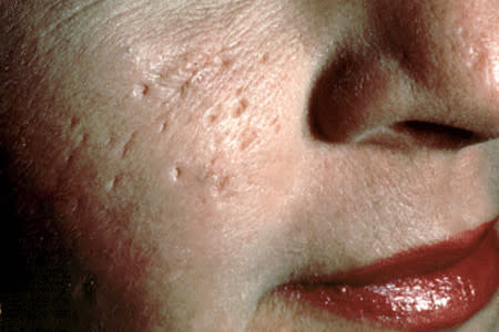 Deep acne scars on woman's cheek
