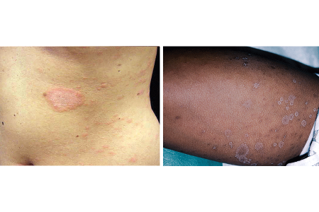 Large herald patch and widespread rash on woman’s torso (left). Widespread pityriasis rosea rash on Black skin (right).