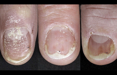 Types of psoriasis on nails