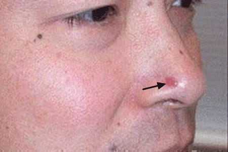 Close-up of basal cell carcinoma on a patient's nose