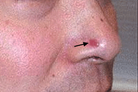 Basal cell carcinoma on nose that patient mistook for acne  