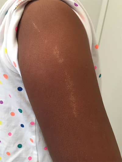 Image of lichen striatus (LS) for DWII