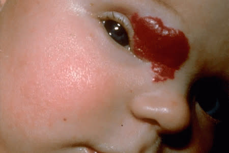 Strawberry hemangioma birthmark over baby's eye
