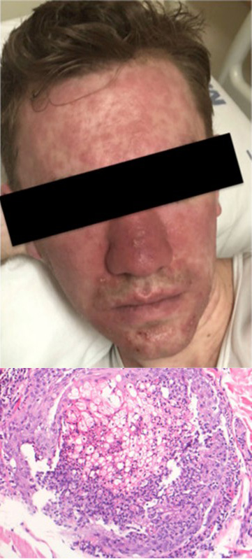 Image for DWII of cutaneous reaction to kava consumption, with a microscope image of the condition