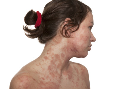 Girl with severe eczema