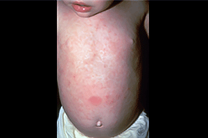 Child with pityriasis rosea