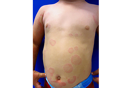 Boy with hives all over his body.