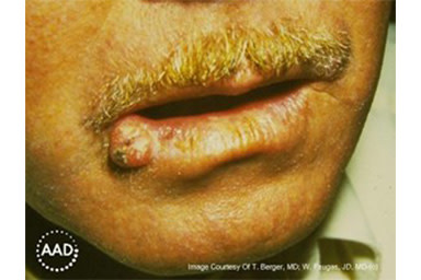 The round growth on this man’s bottom lip is a type of skin cancer known as squamous cell carcinoma | American Academy of Dermatology (AAD).