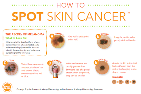 Moles Skin Cancer Warning Signs