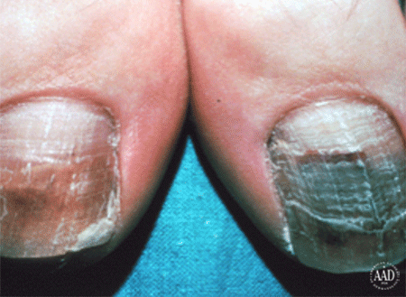 Nails with ringworm infection