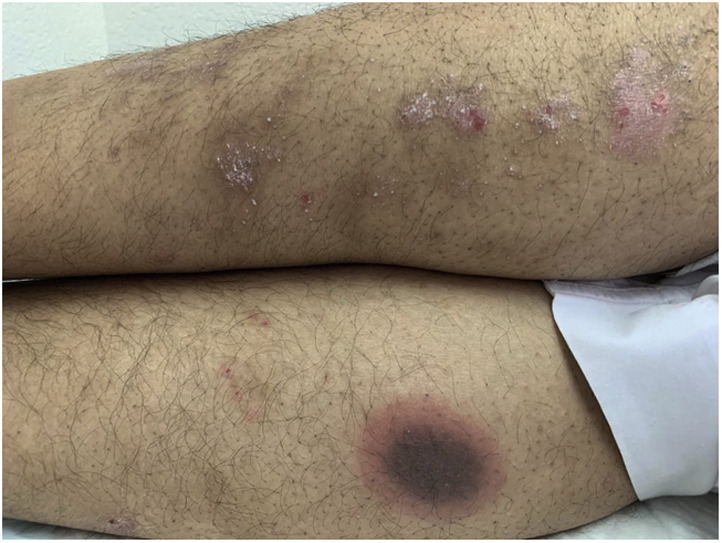 Image for DWII of fixed drug eruption