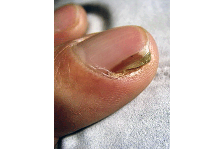 Brown streak beneath this fingernail is squamous cell skin cancer