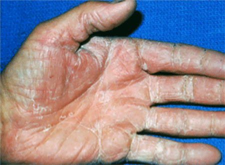 Hand with a ringworm infection