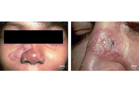 Discoid lupus rash